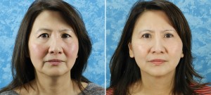 Face Lift and Upper & Lower Blepharoplasty